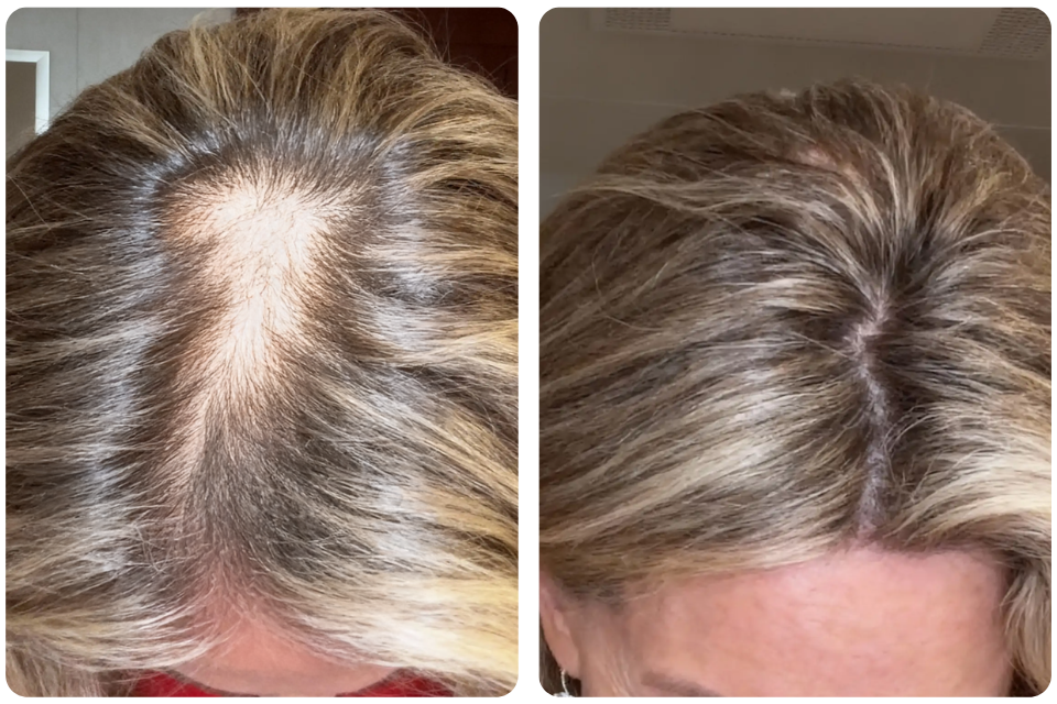 A before-and-after comparison of a woman's hair, showing regrowth in a thinning area after three months.