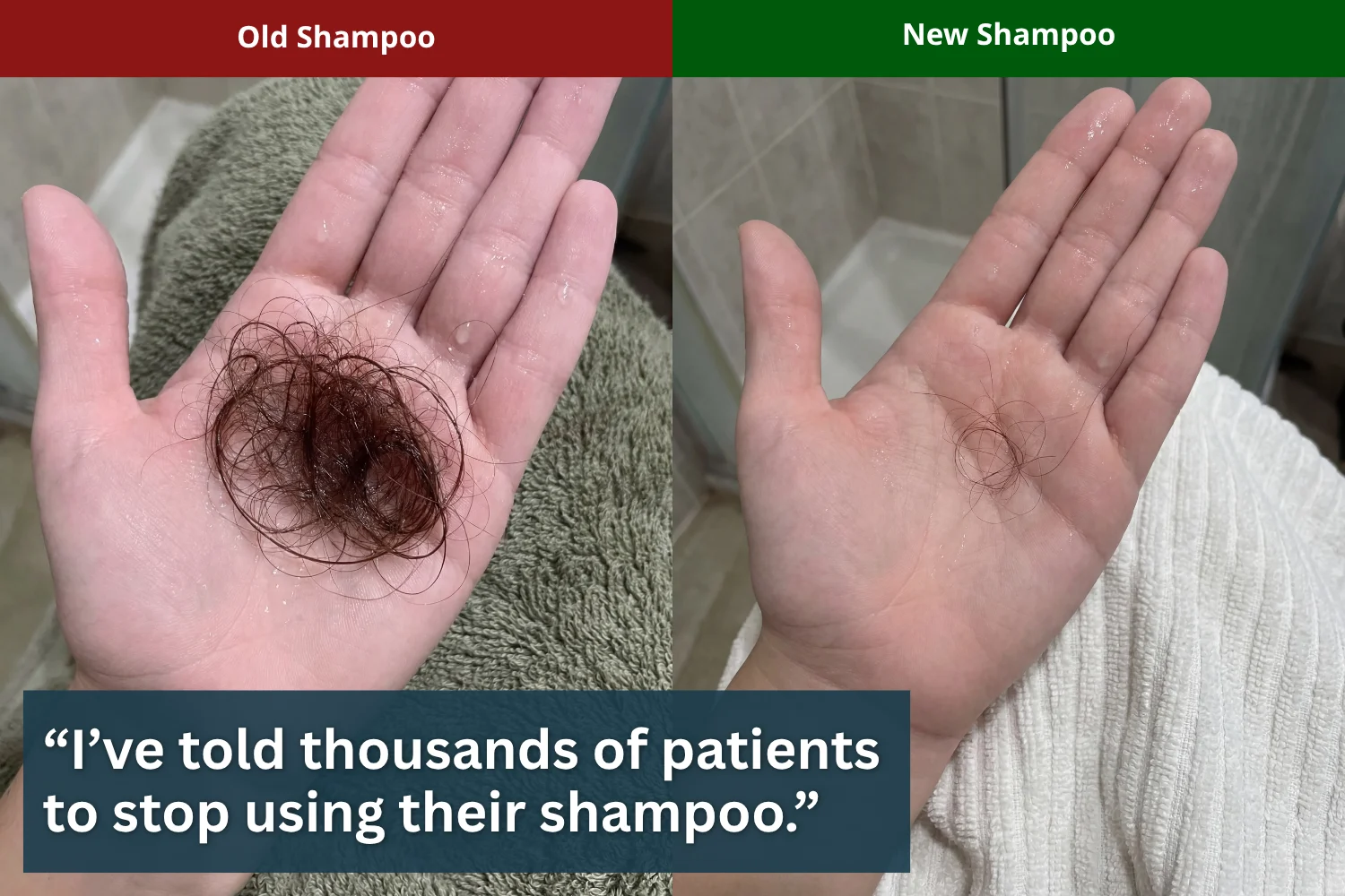 Before and after: clump vs few hairs; overlay: 'I've told thousands of patients to stop using their shampoo'