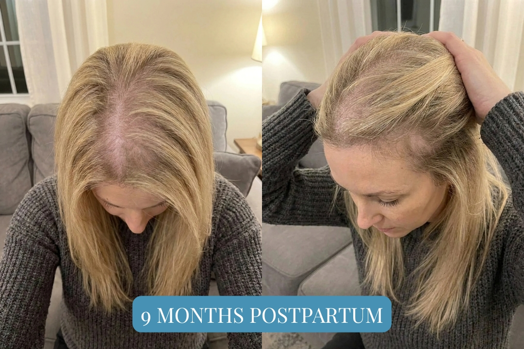 Client A at 9 months postpartum, hair not recovered