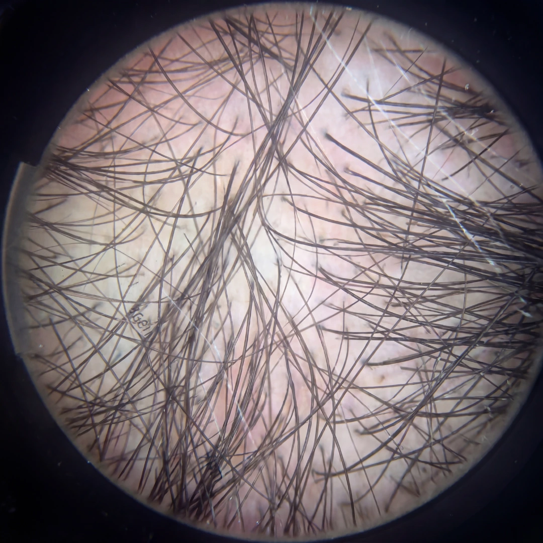 Trichoscopy at week 12 &mdash; +10,200 new strands
