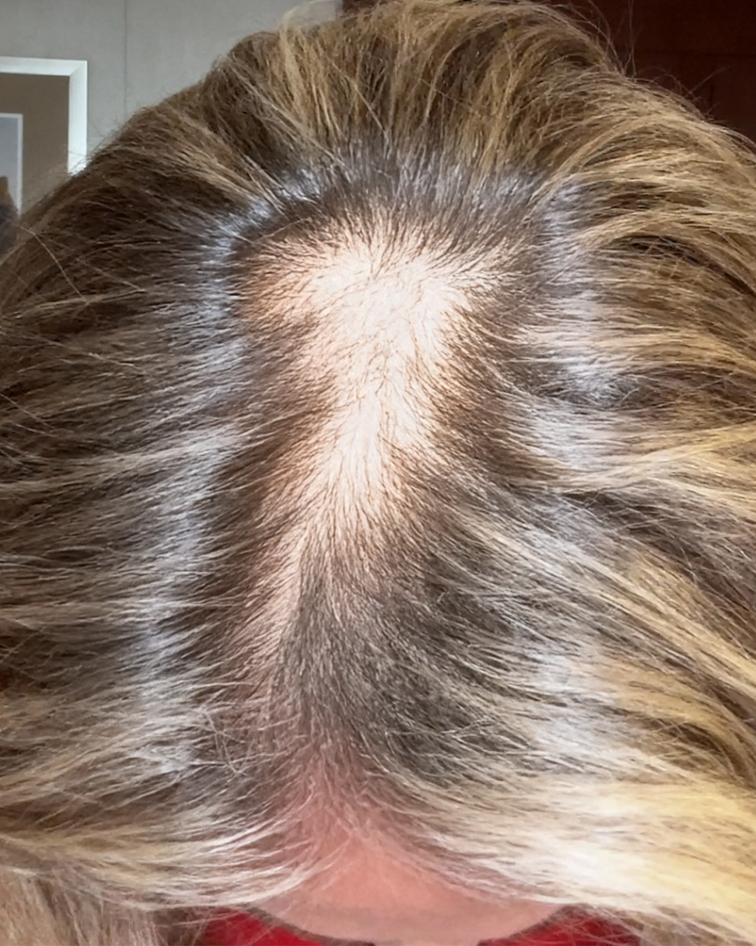 Top view of a person's scalp with thinning hair.