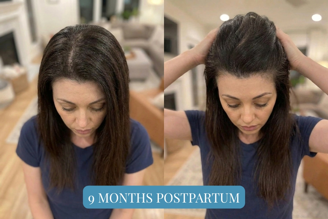 Client B at 9 months postpartum, density returning