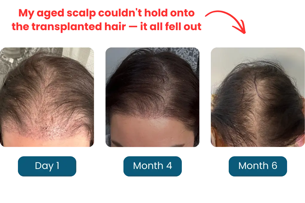 A three-photo comparison showing the process of transplanted hair follicles falling out on a woman's scalp.