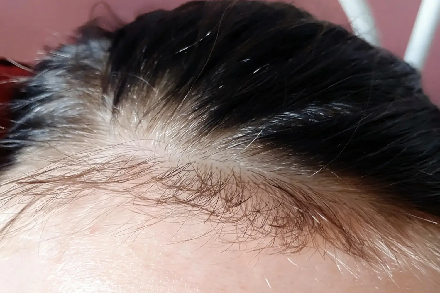 Close-up of front hairline showing short baby hairs and mild thinning at the scalp