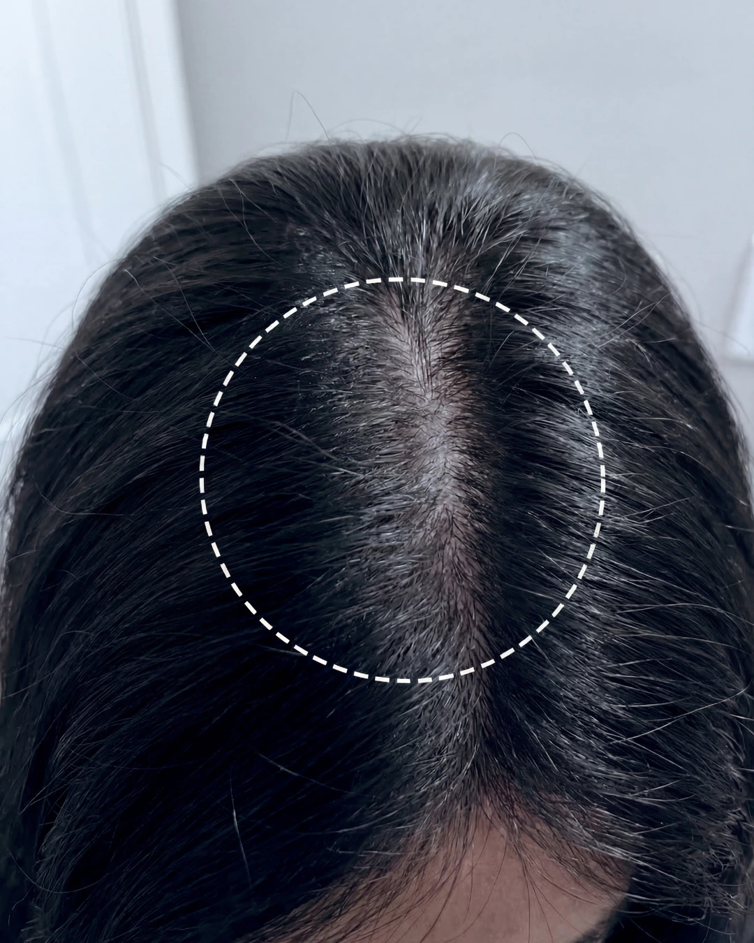 Top of scalp after 12 weeks of KilgourMD use showing increased hair density at the part line inside dashed circle