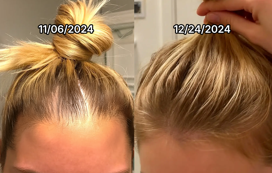 Two images showing hair growth over time, dated November and December 2024.