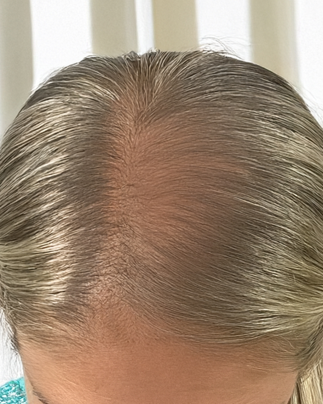 Top view of a person's scalp showing hair thinning.