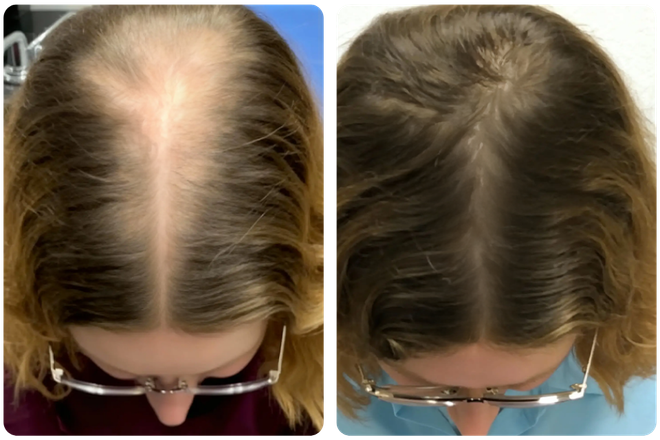 A before-and-after image of a woman's hair part, showing increased hair density and less visible scalp.
