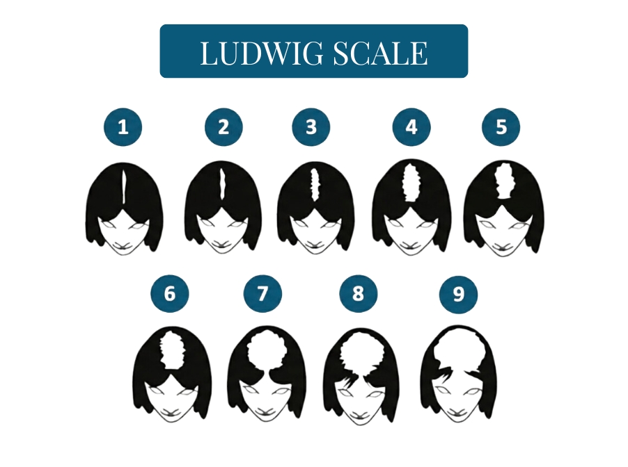 An illustration of the Ludwig Scale, showing nine numbered stages of female pattern hair loss.