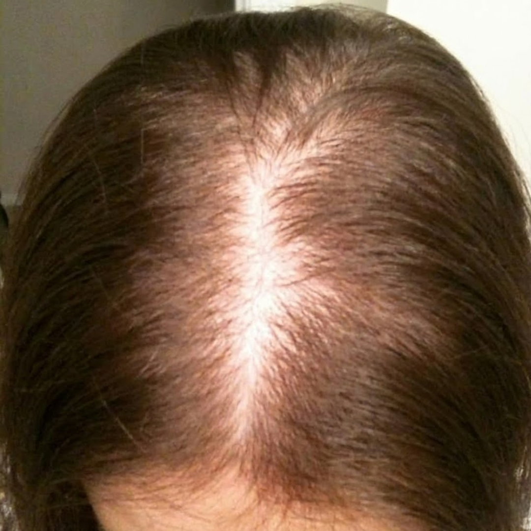 Close-up of a person's scalp with thinning hair.