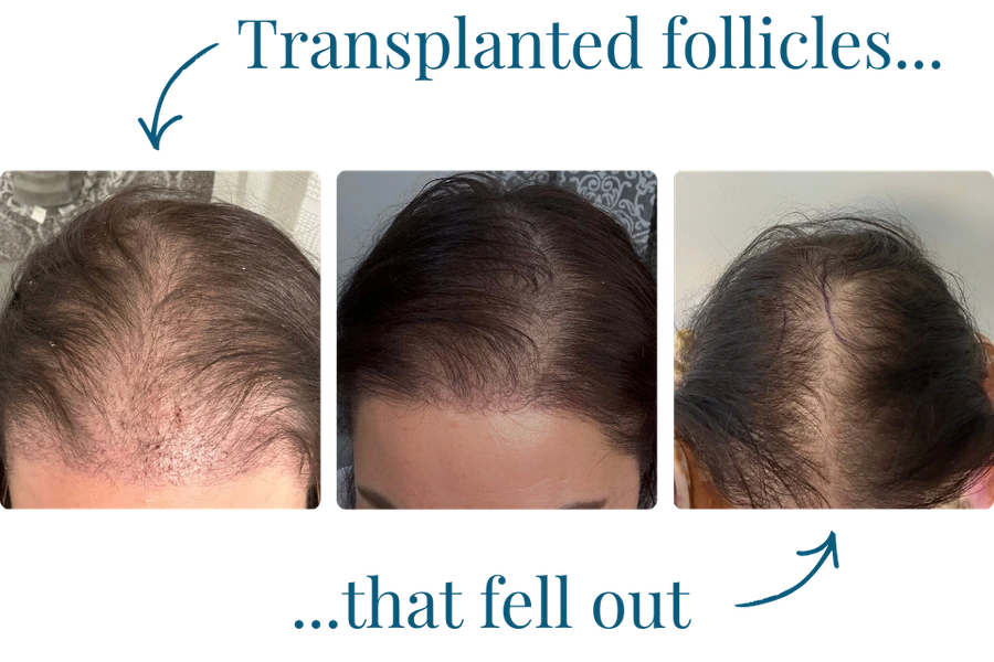 A three-photo comparison showing the process of transplanted hair follicles falling out on a woman's scalp.