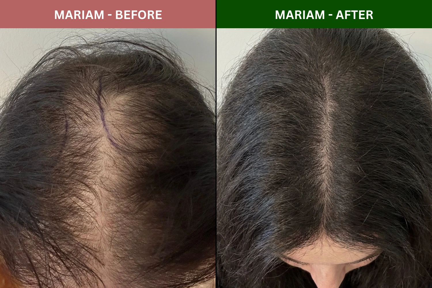A before-and-after image showing a woman's scalp with thinning hair on the left and thicker hair on the right.