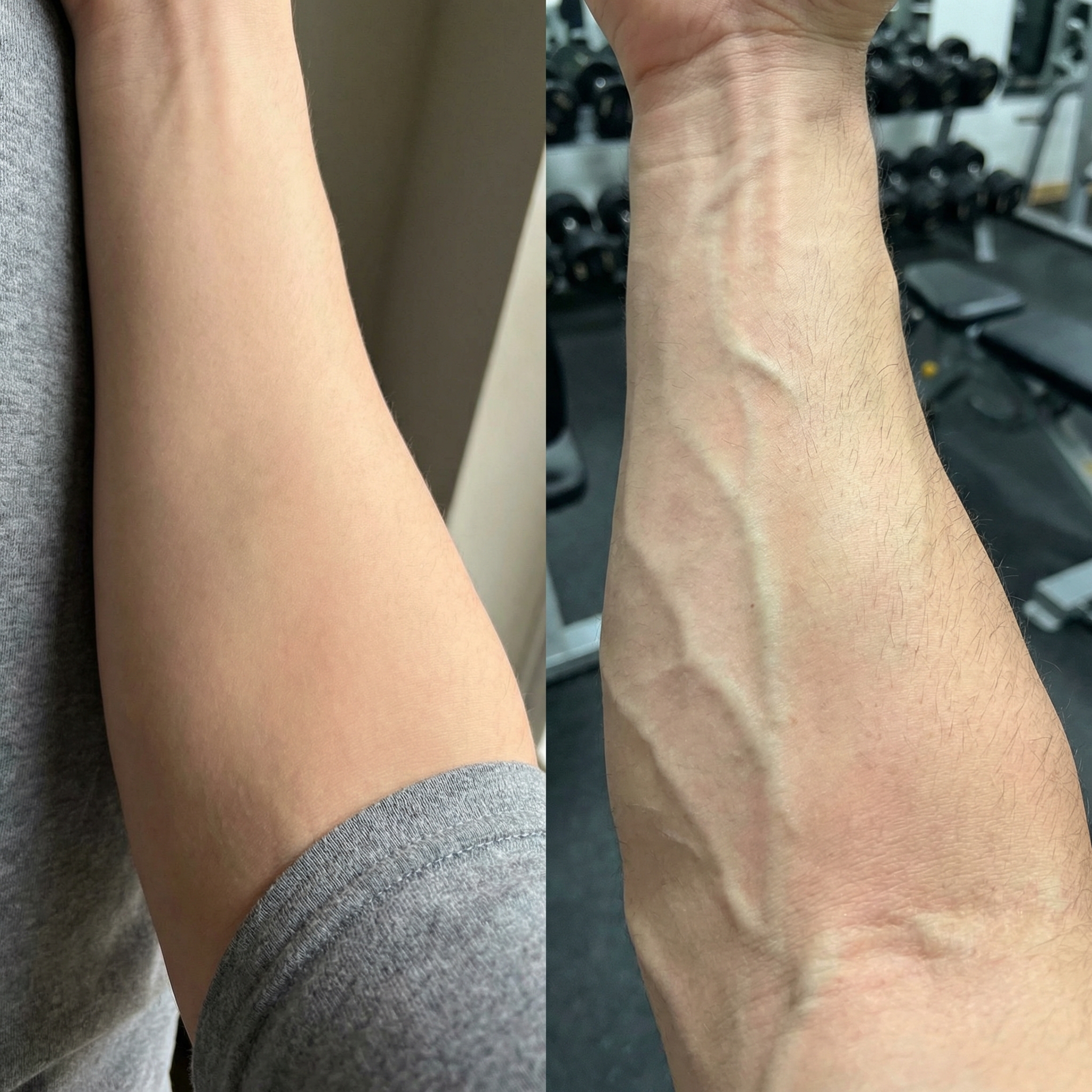 A side-by-side comparison of a forearm, one smooth and one with prominent, bulging veins.