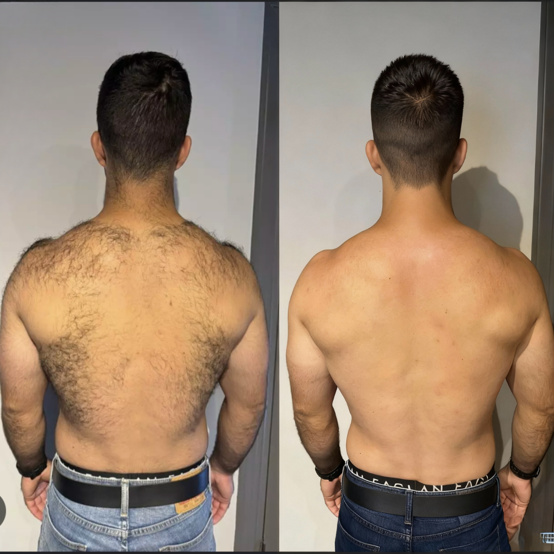 Two side-by-side images showing a person's back before and after hair removal.