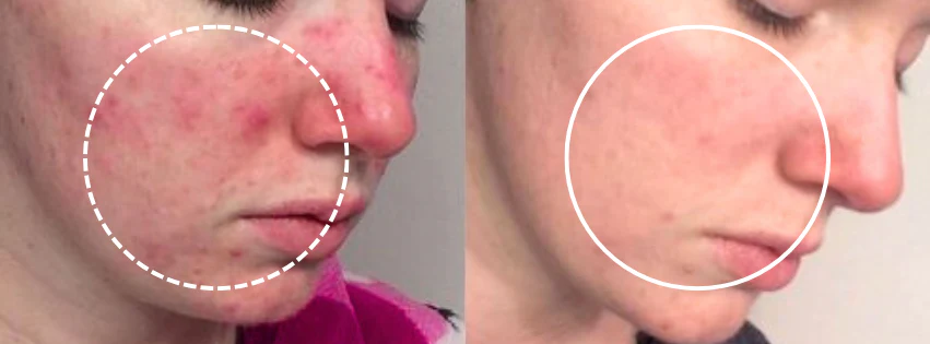 Side-by-side comparison of a person's cheek with and without redness.