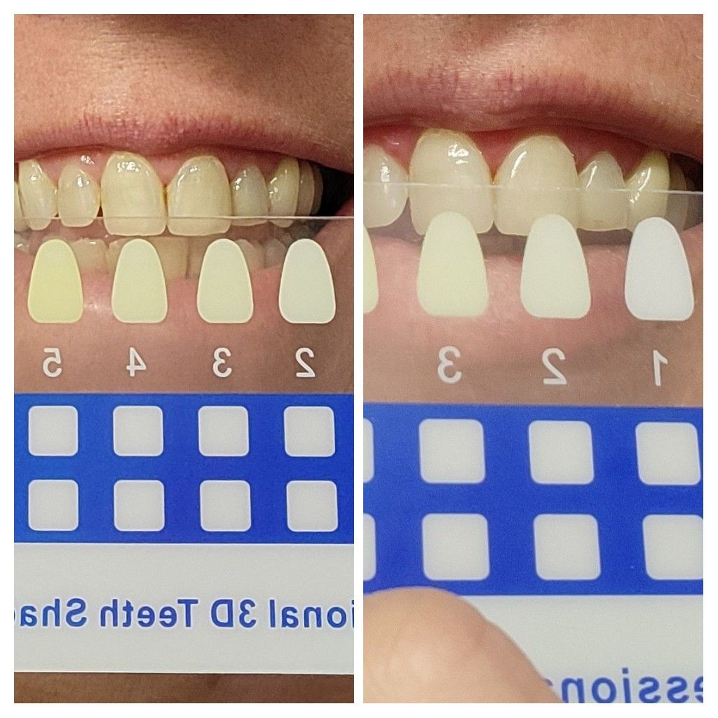 Teeth shade comparison using a dental shade guide with numbered samples.