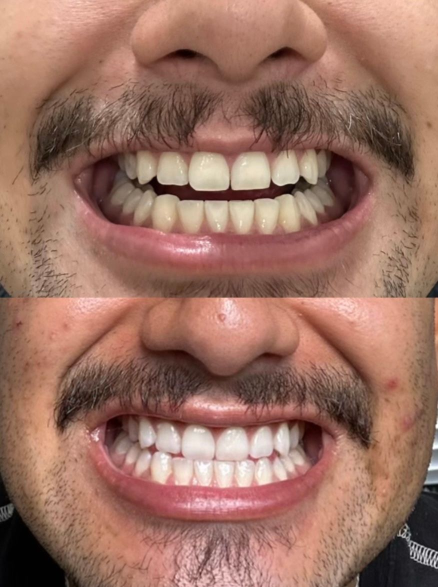 Two close-up images of the same person's teeth, showing before and after changes.