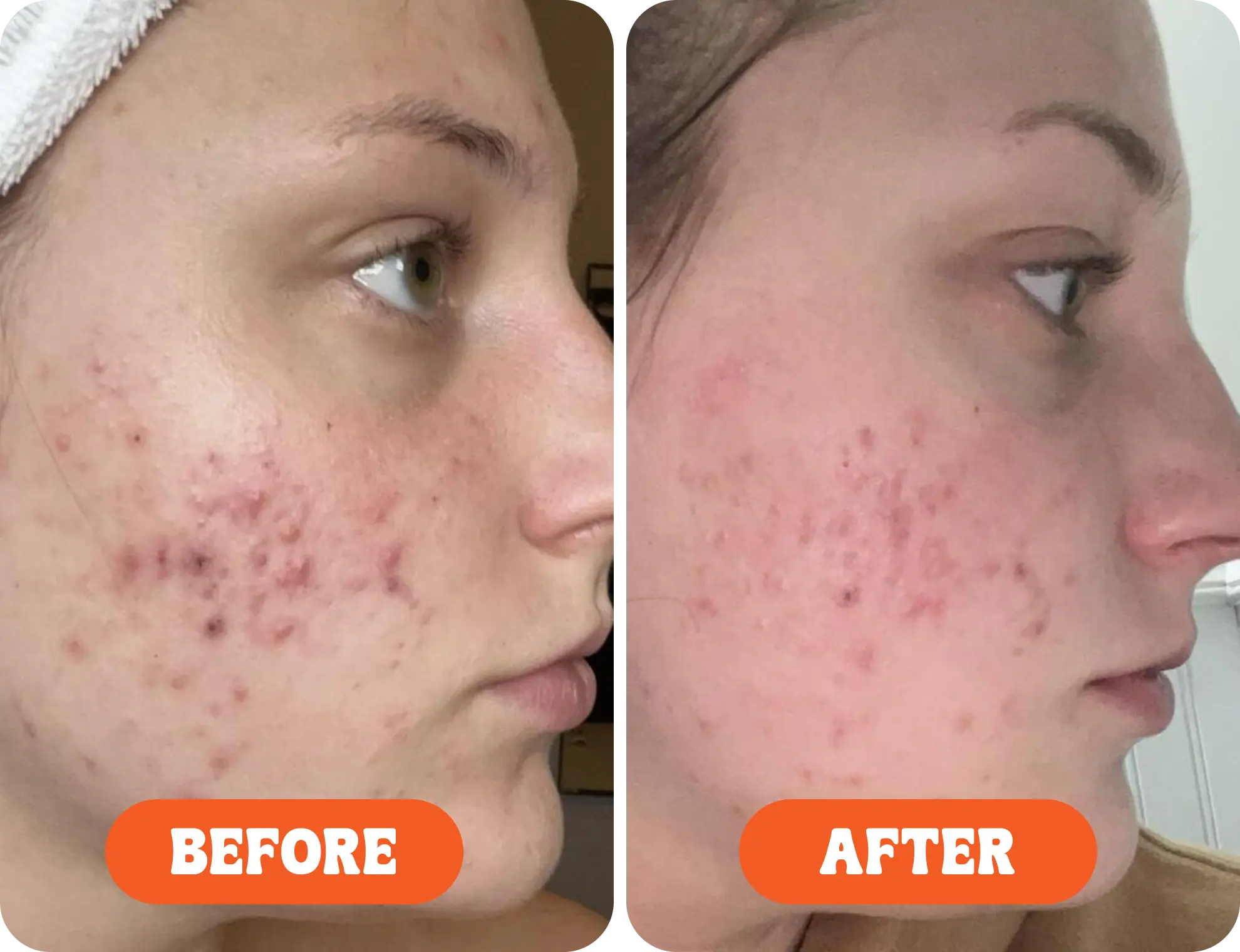 Side-by-side comparison of acne treatment before and after on a person's cheek.