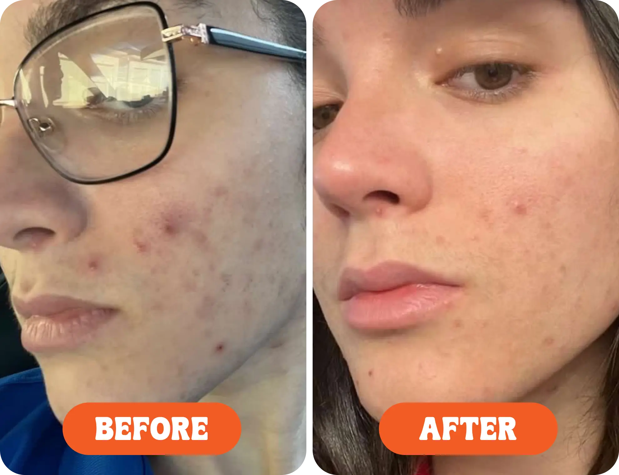 Side-by-side comparison of a face before and after acne treatment.