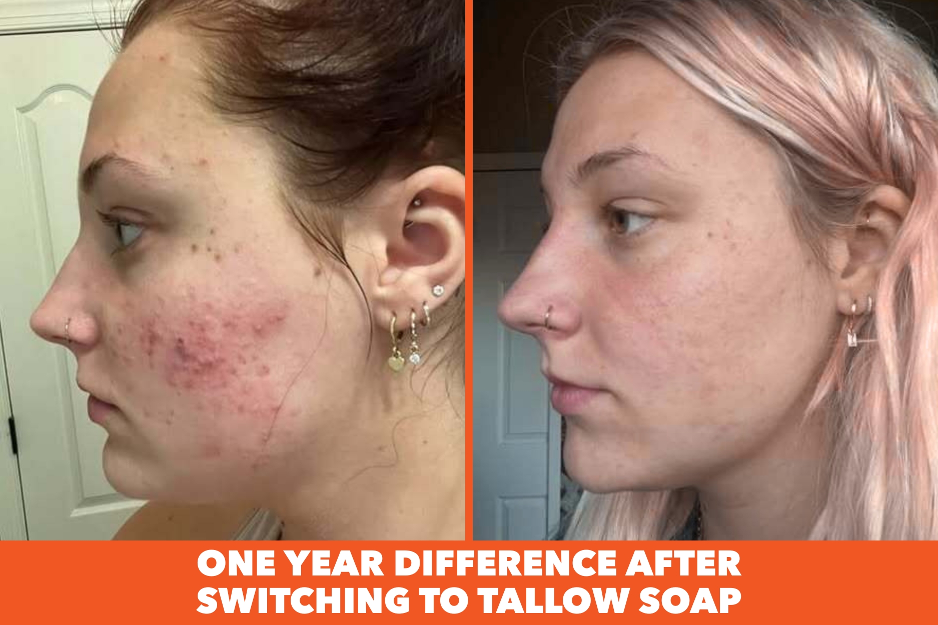 Before-and-after photos of a woman's profile, showing a significant reduction in acne on her cheek.