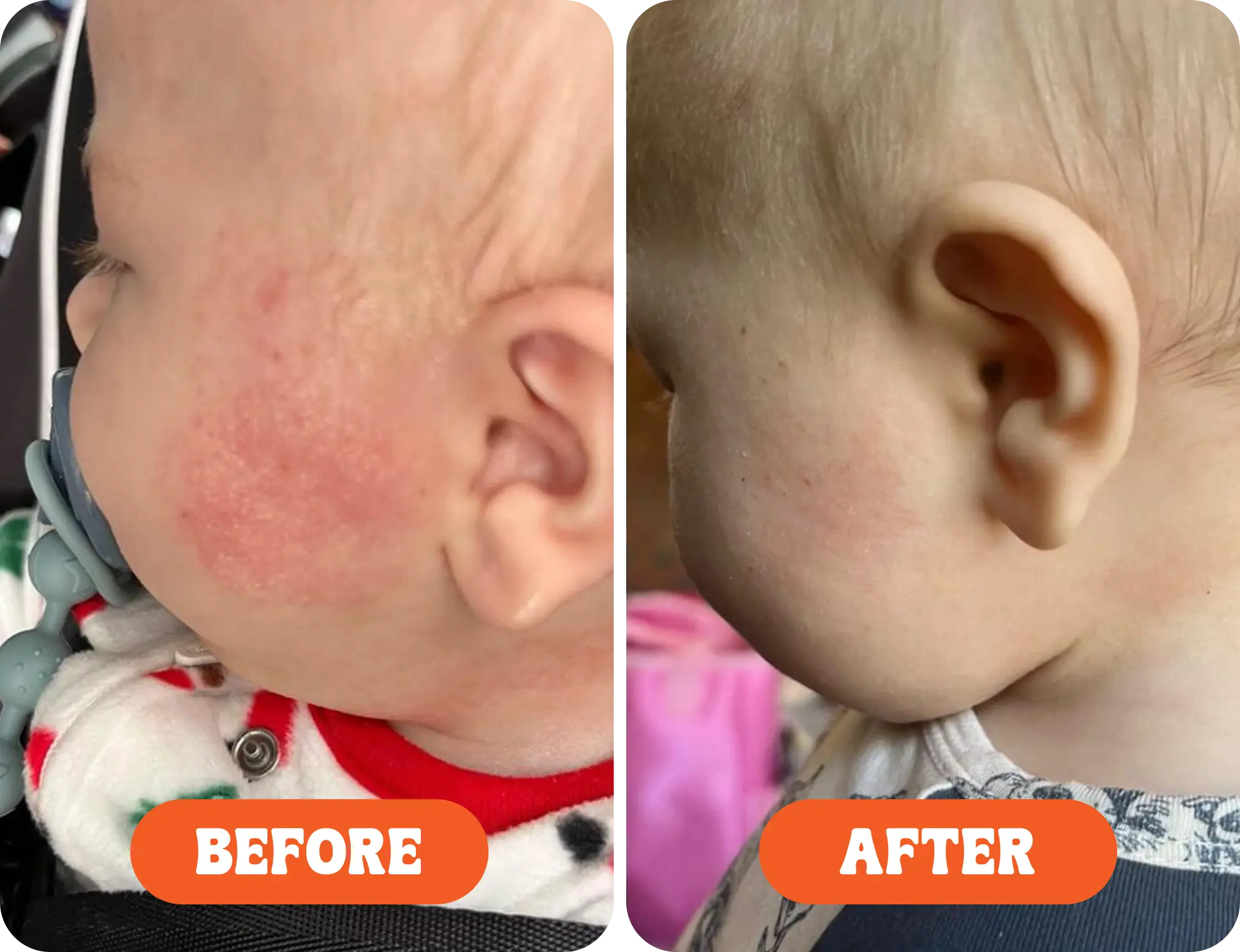 Side-by-side comparison of a baby's cheek before and after treatment.