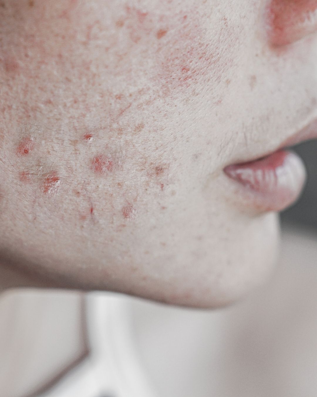 Close-up of a person's skin with acne and redness.
