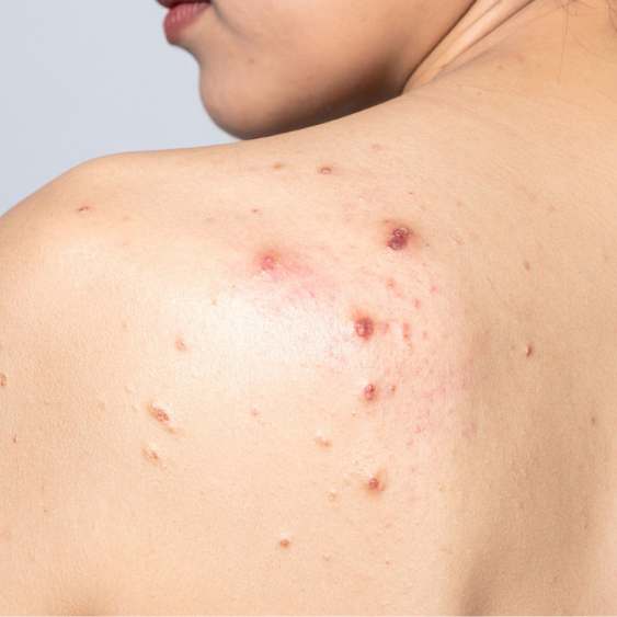 Acné dos décolleté