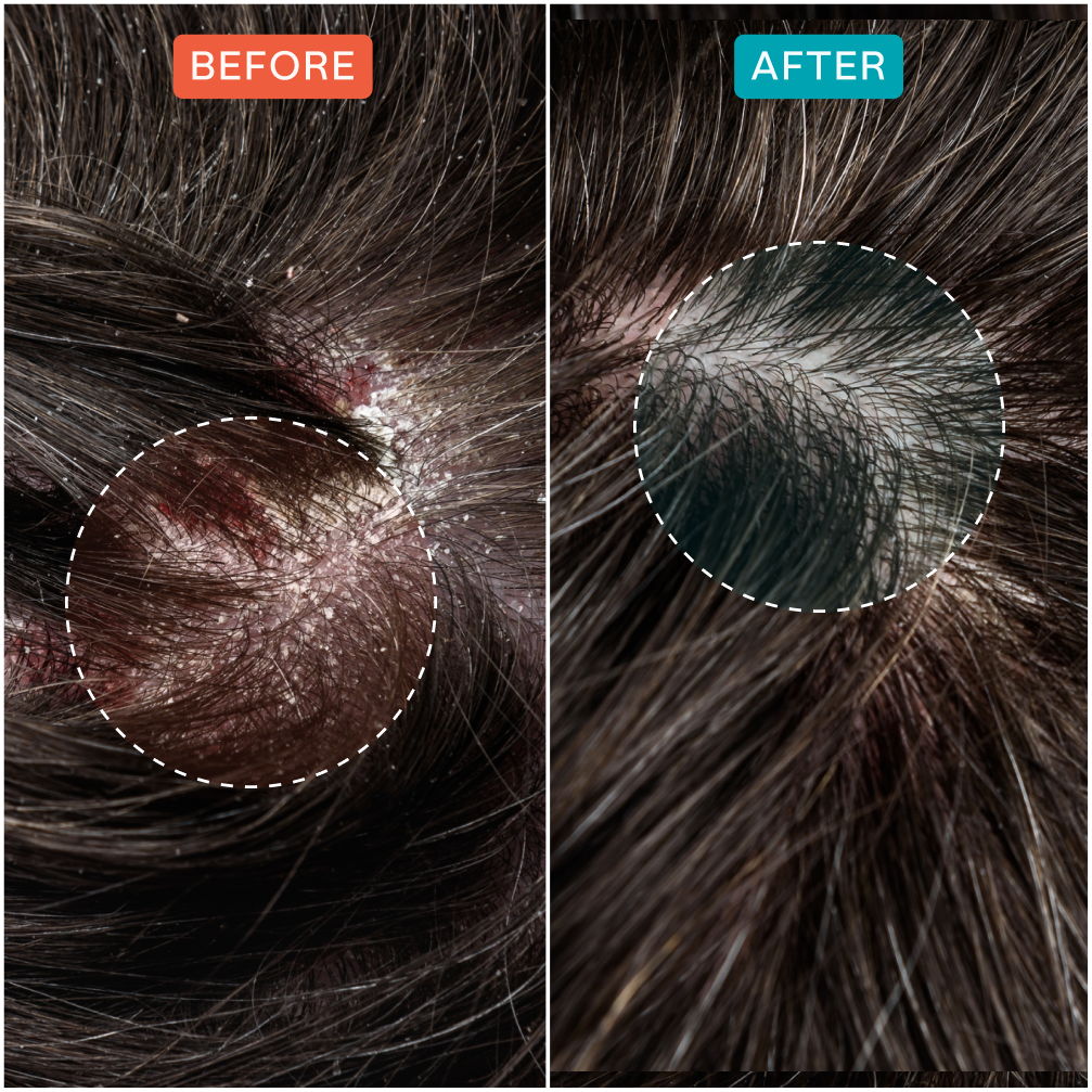 Side-by-side comparison of scalp before and after treatment.