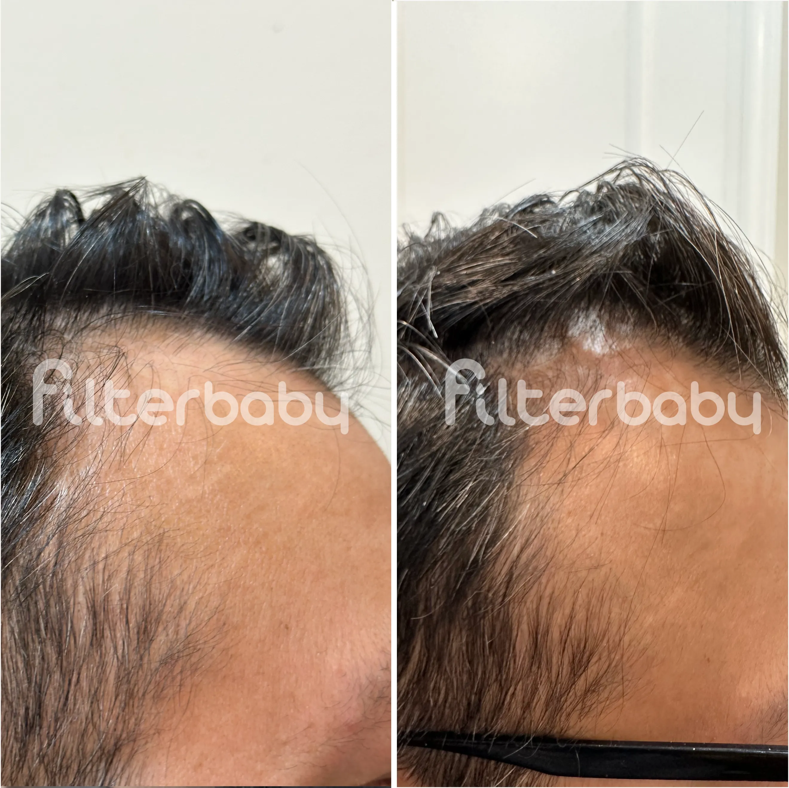 A side-by-side comparison of a person's hairline, with a white patch appearing in the hair on the right.
