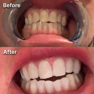 A before and after image showing the results of a teeth whitening treatment.