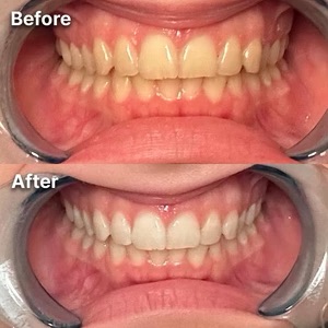 A before and after comparison of teeth whitening, showing yellower teeth before and whiter teeth after treatment.