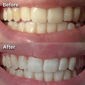A before and after comparison of teeth whitening, with the bottom photo showing significantly whiter teeth.