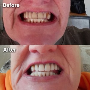 A before-and-after comparison showing a person's teeth, which are significantly whiter in the after photo.