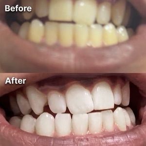 A before-and-after comparison of teeth, showing the results of a whitening treatment.