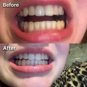 A before-and-after image showing a person's teeth, which are visibly whiter in the after photo.