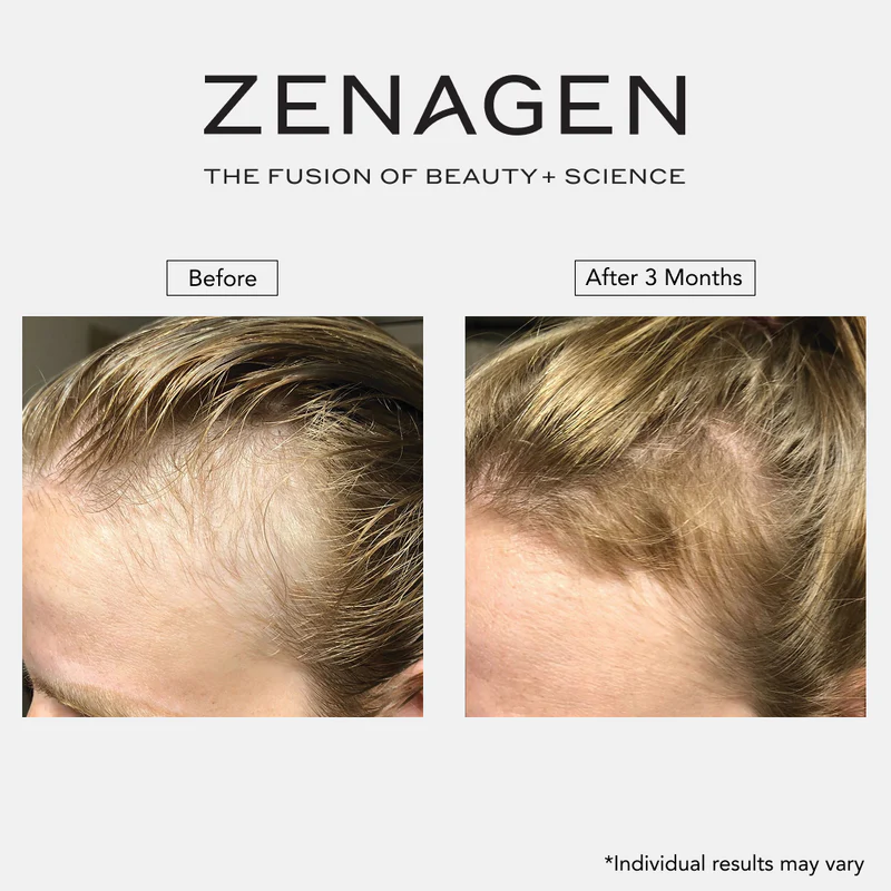 Before and after photos showing increased hair growth and thickness at a person's hairline after three months.