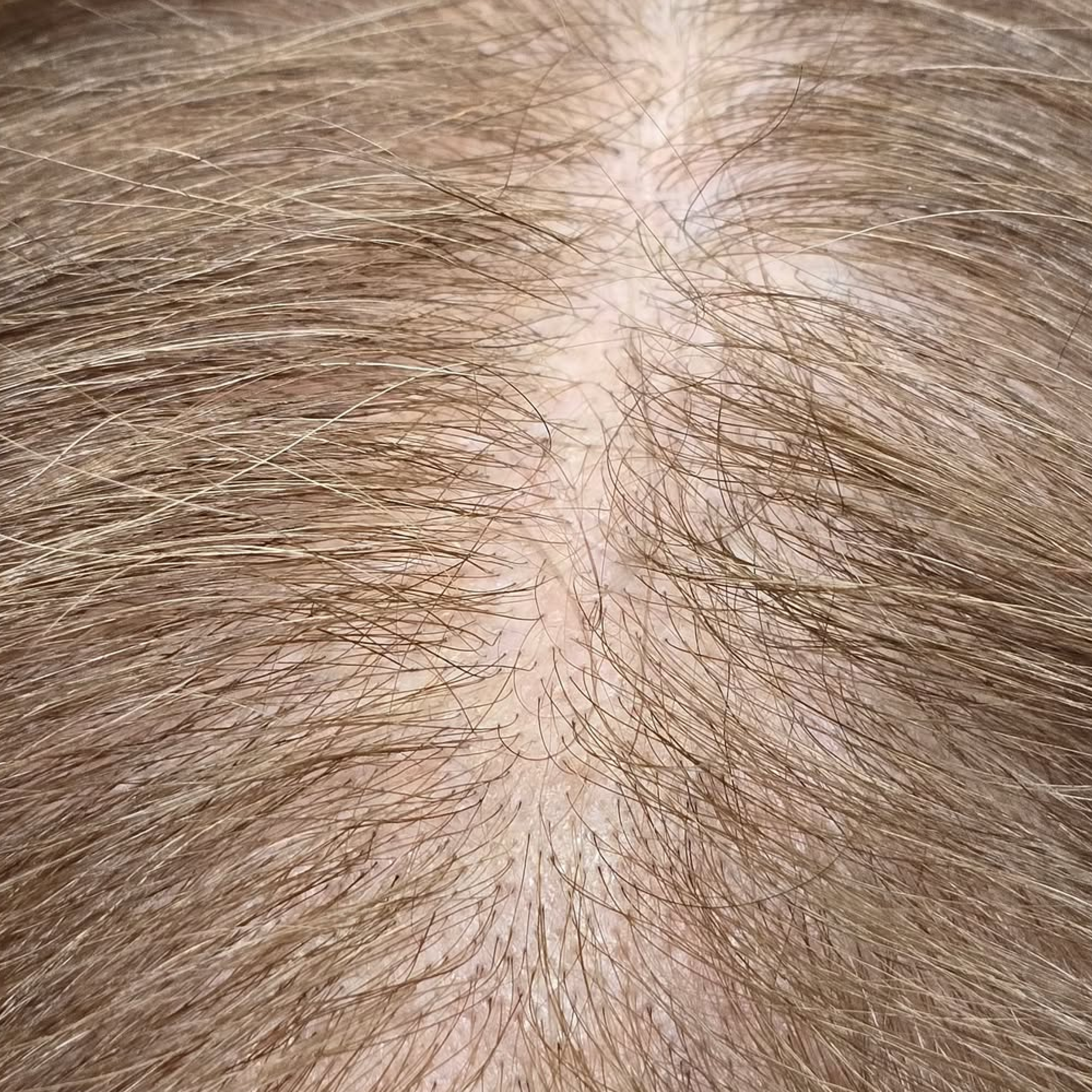 A close-up, top-down view of a scalp with thinning, light brown hair parted in the center.