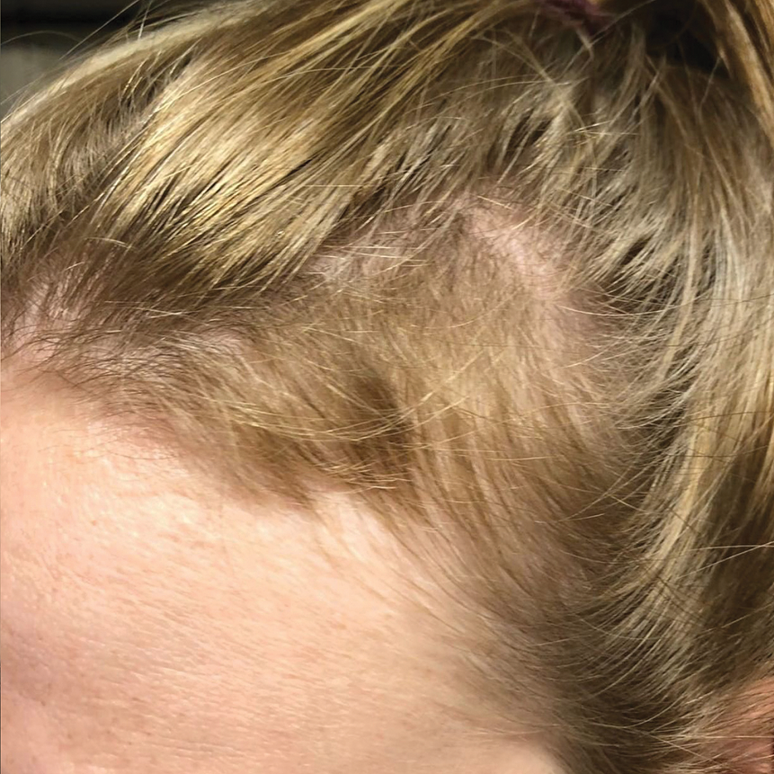 A close-up of a person's scalp showing a patch of thinning blonde hair near the forehead.