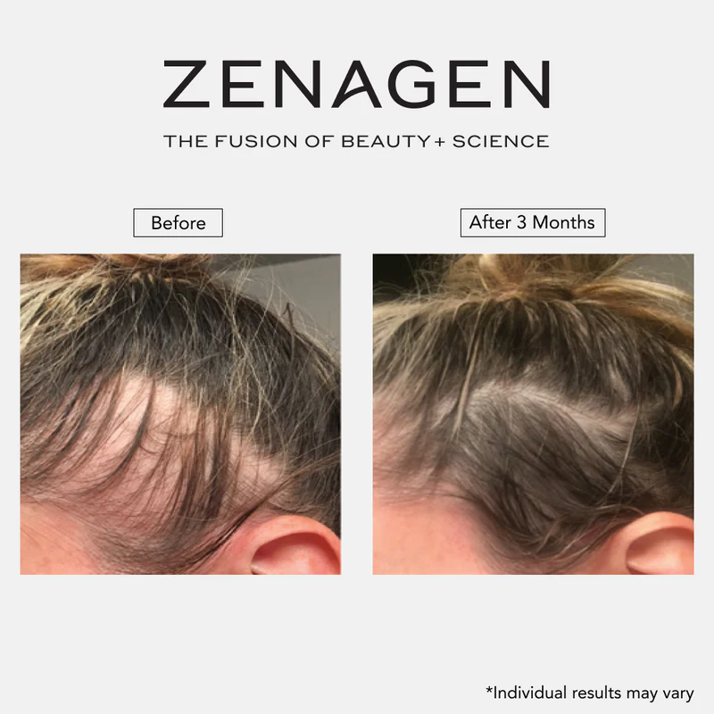A before and after comparison of a person's hairline, showing increased hair growth after three months.