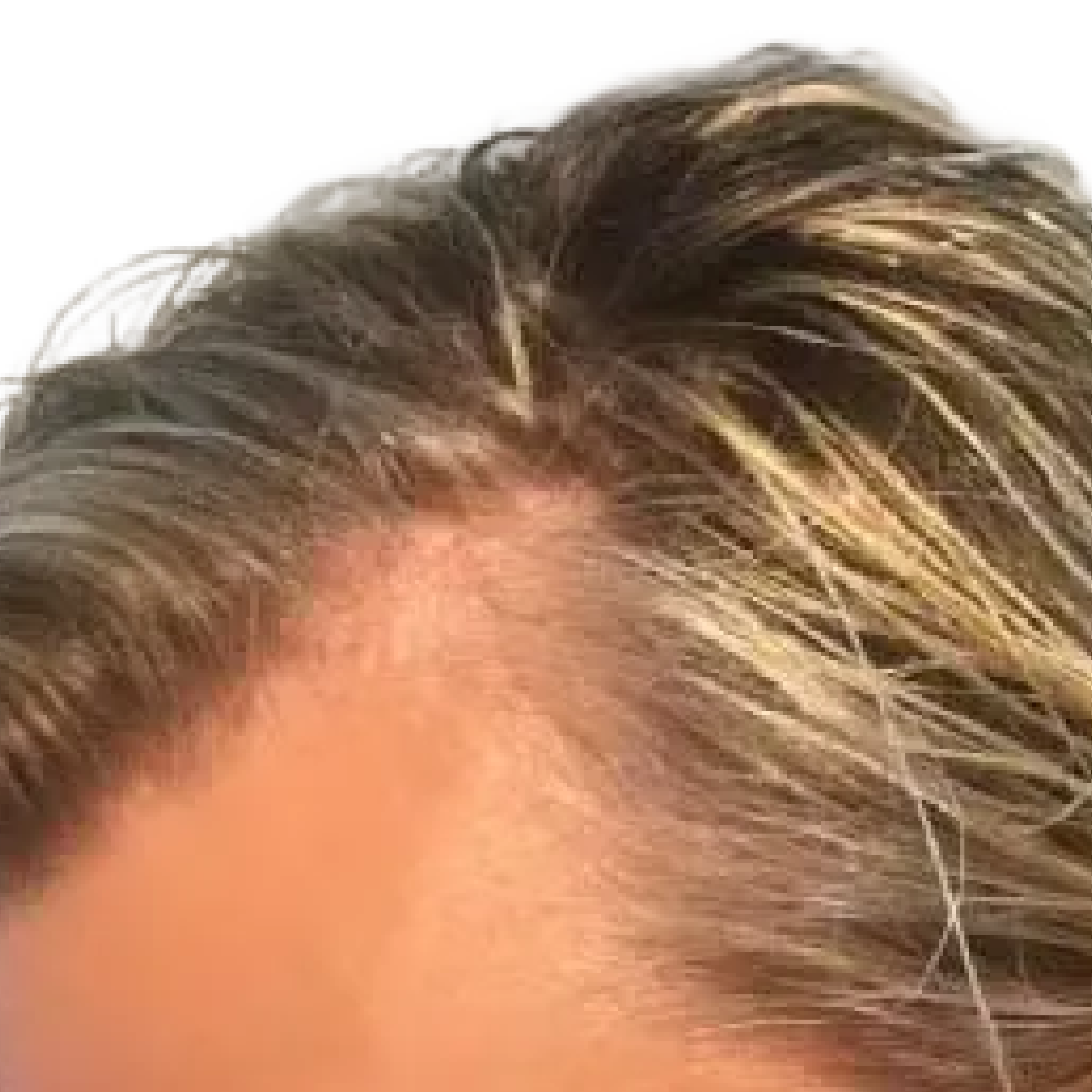 A close-up view of a person's thinning hairline with light brown and blonde hair.