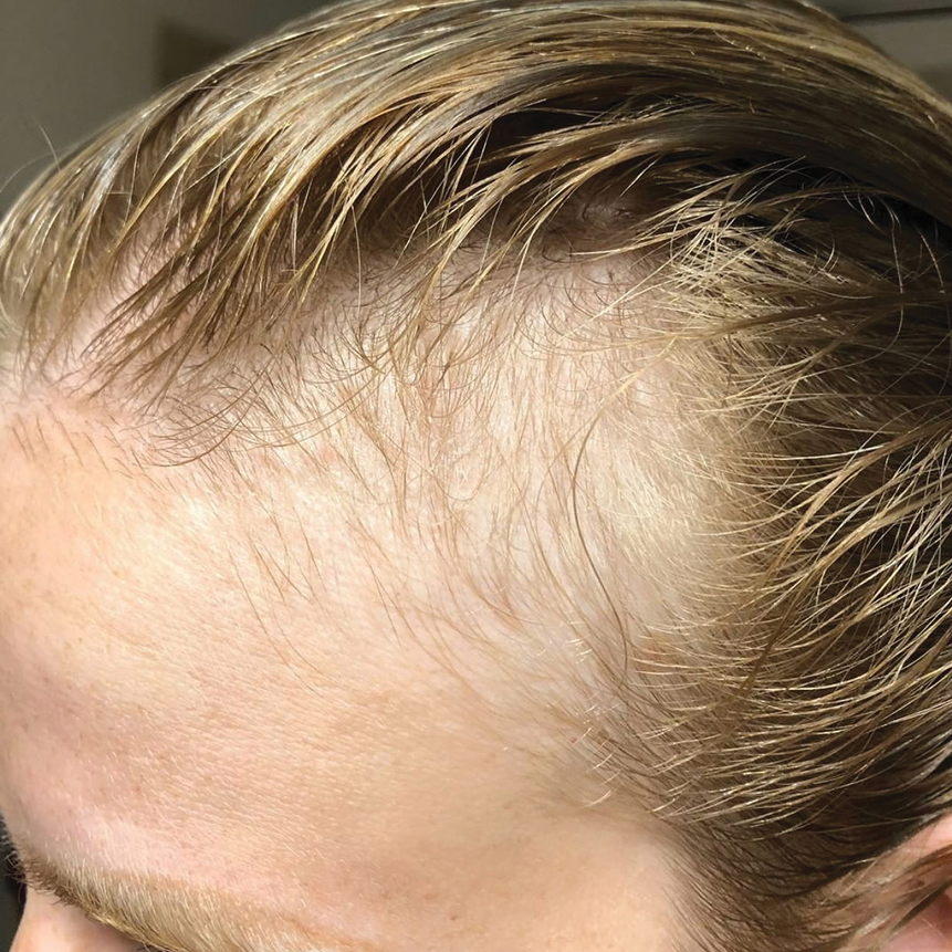 A close-up of a person's forehead showing a thinning, blond hairline.