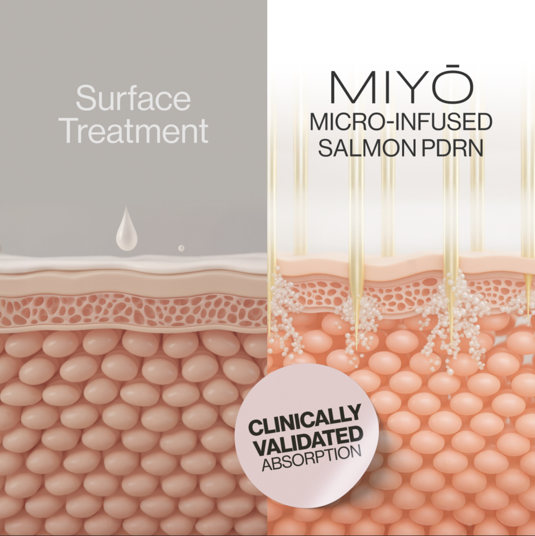 Illustration of skin layers with surface treatment and micro-infused salmon PDRN.