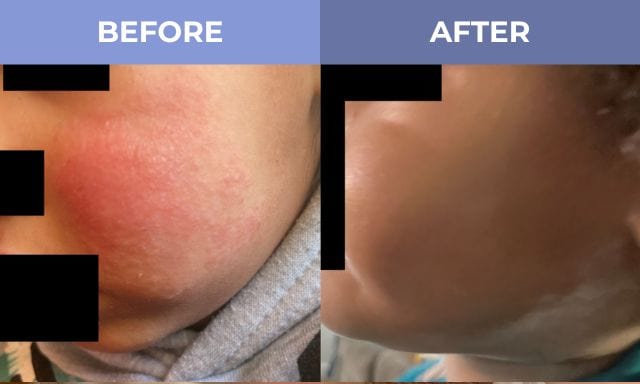 Before and after close-up images showing a red rash on a cheek that has cleared up.