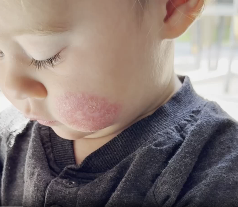 A close-up of a young child with a red, flaky patch of skin on their cheek.