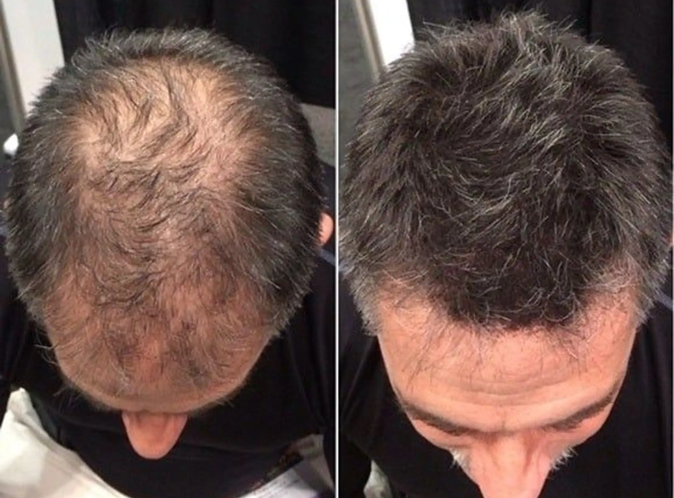 Before and after images showing hair regrowth on a man's scalp.