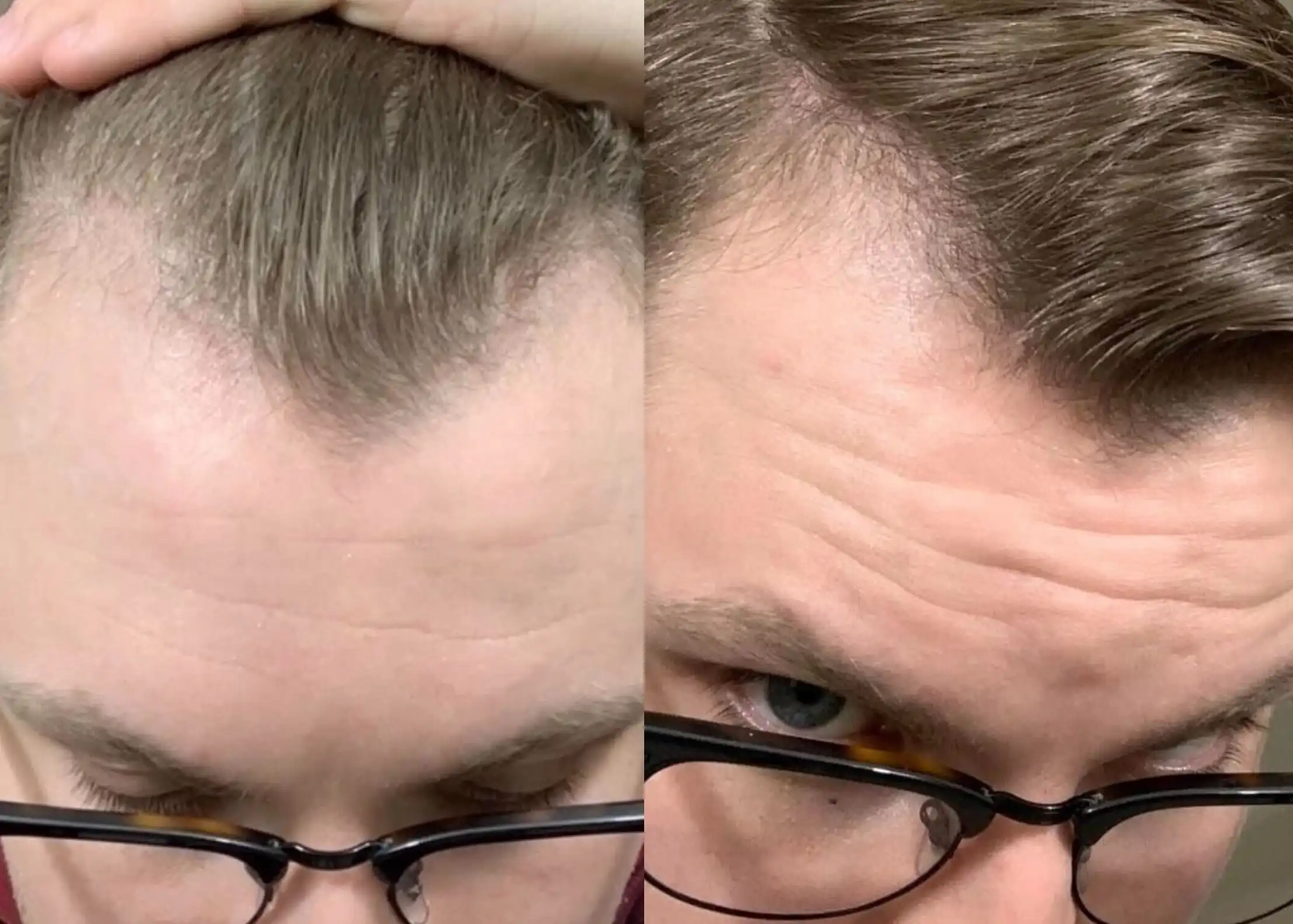 Side-by-side comparison of a person's hairline before and after treatment.