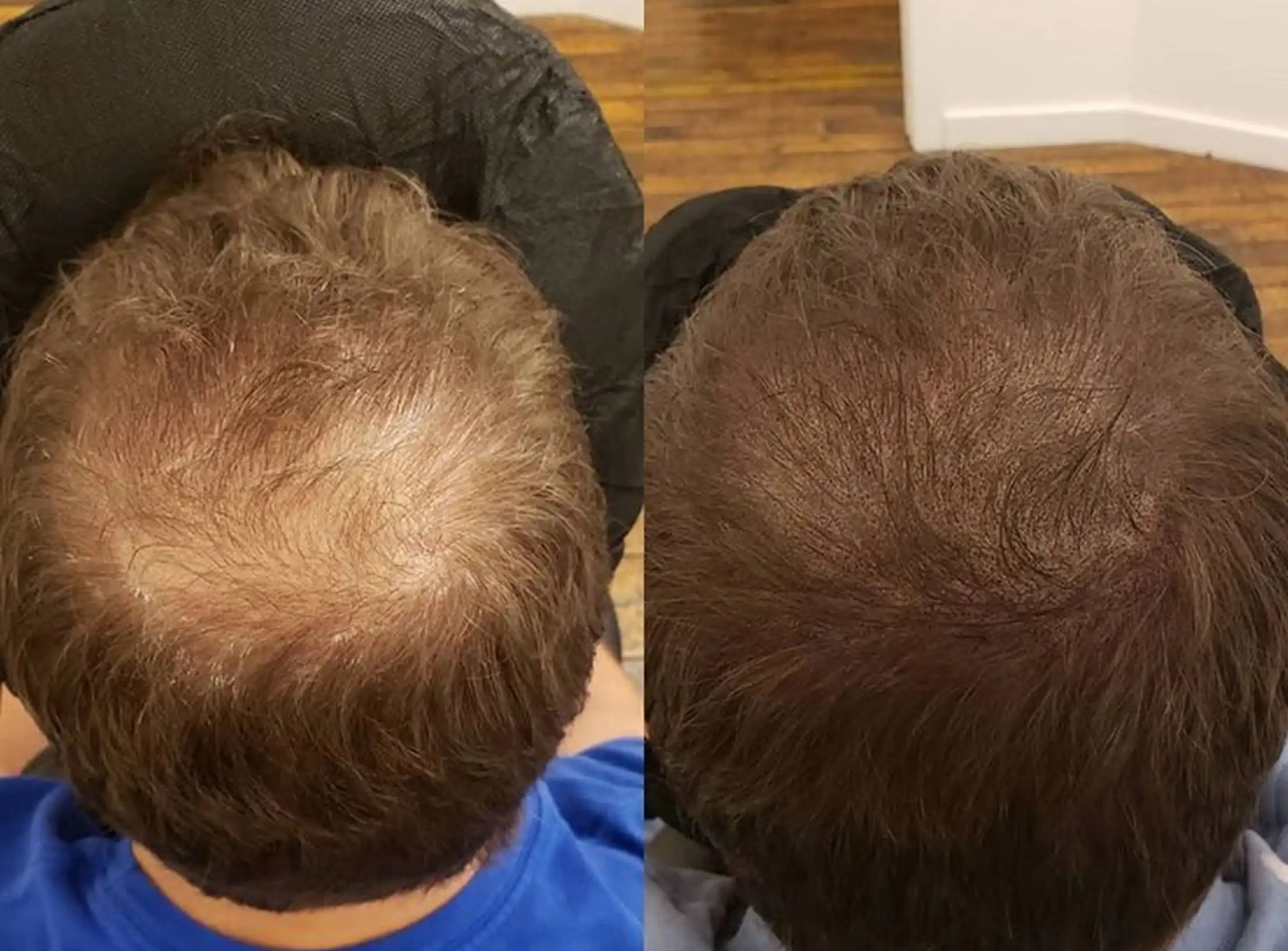 Two side-by-side images showing a man's scalp before and after hair treatment.