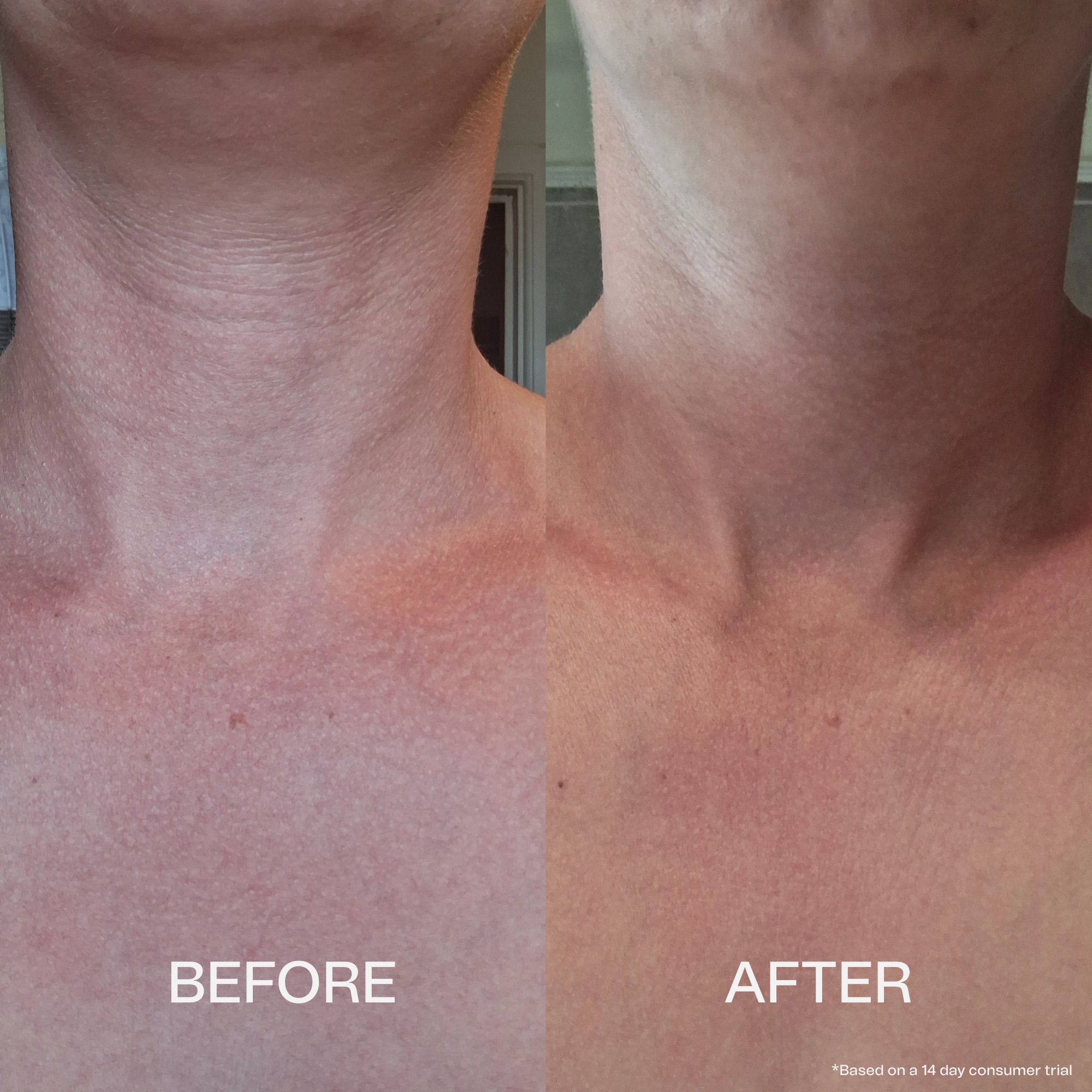 Before and after comparison of skin on a person's neck, showing smoother skin in the after photo.