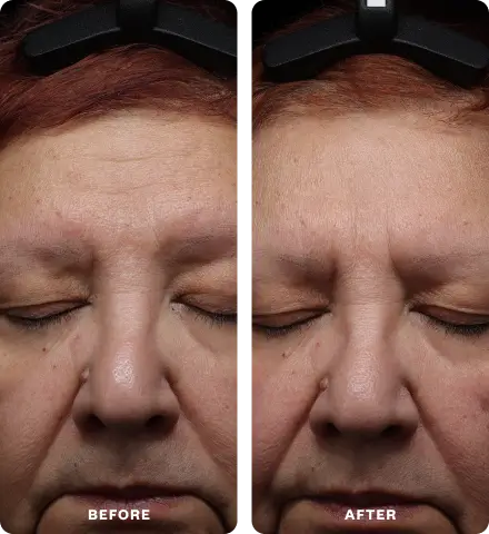Before and after close-up photos of a woman's forehead, showing a visible reduction in wrinkles and fine lines.