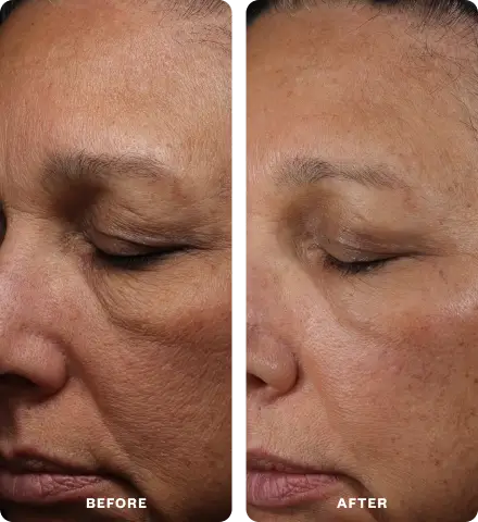 Before and after close-up photos of a woman's face showing a reduction in wrinkles and fine lines.